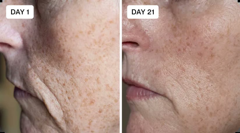 Bessie, 55+, before and after micro-infusion results