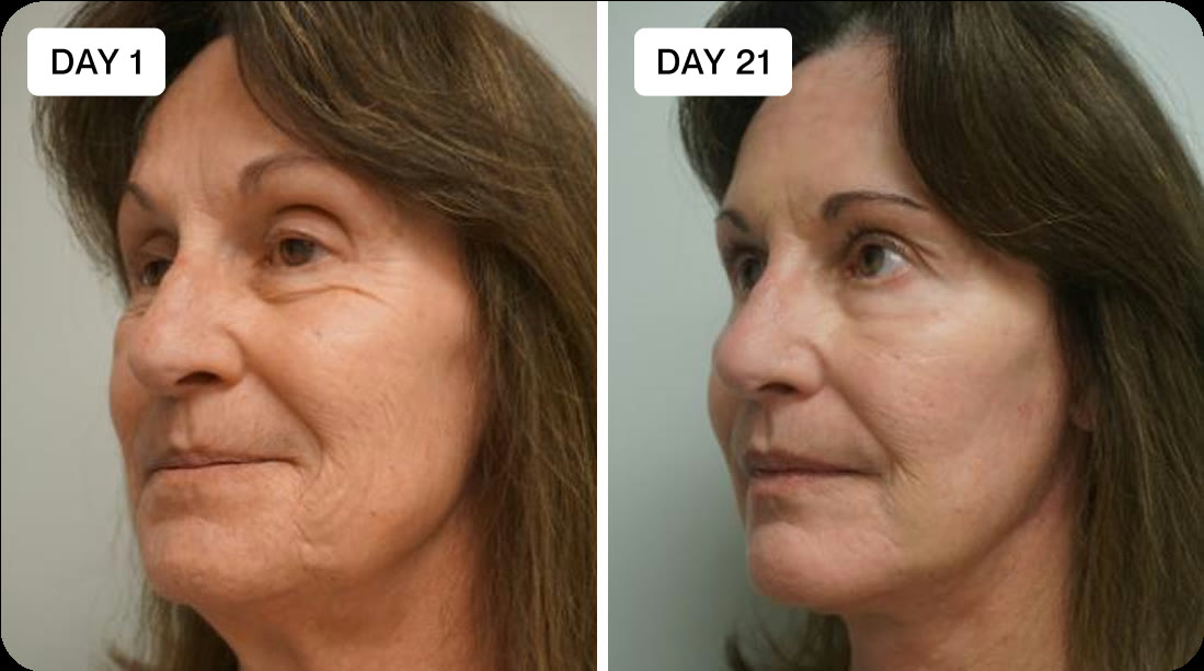 Claire, 60+, before and after micro-infusion results