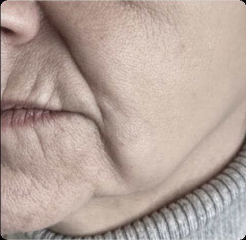 Jowls along the jawline