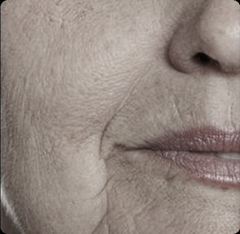 Marionette lines around the mouth