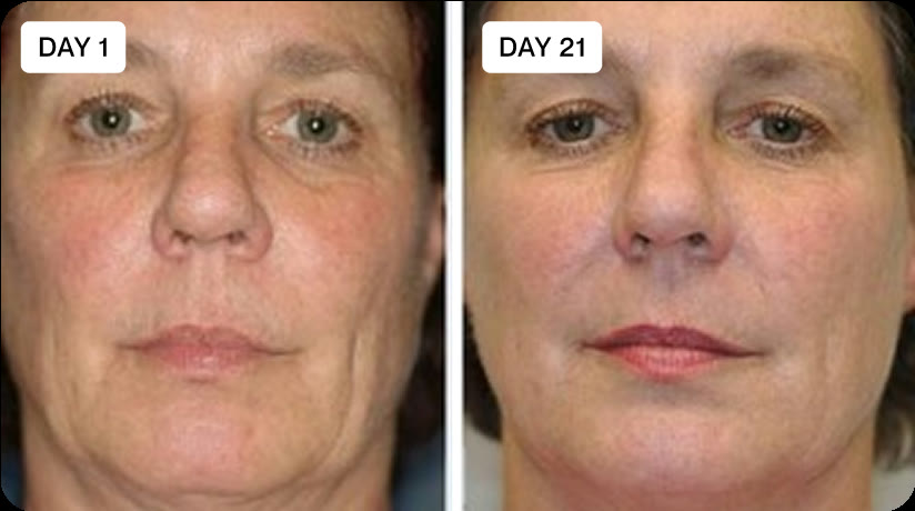 Priscilla, 58, before and after micro-infusion results