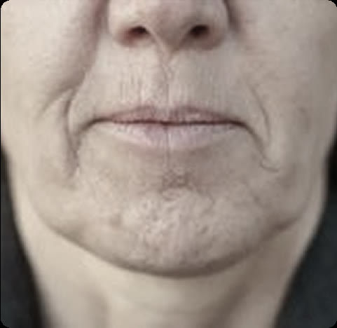 Saggy skin on the face and neck