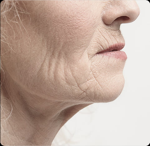 Deep wrinkles around the mouth