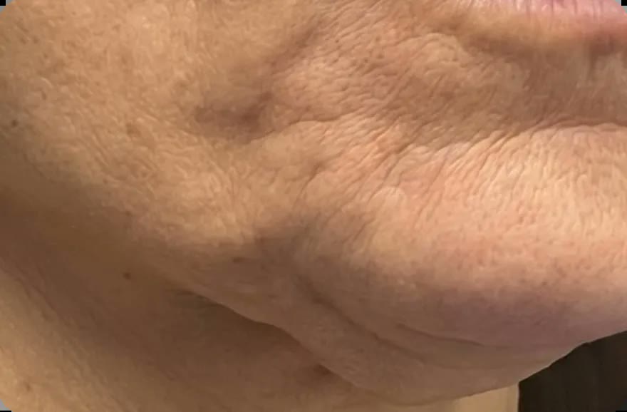 Days 1-7 of micro-infusion results