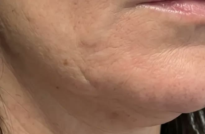 Days 7-14 of micro-infusion results