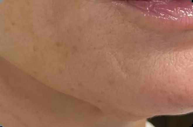 Days 14-21 of micro-infusion results